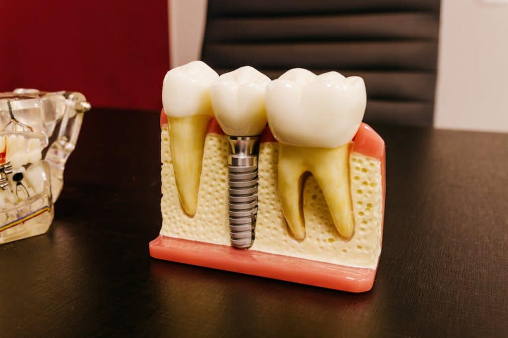 Implantes dentales Parque Goya