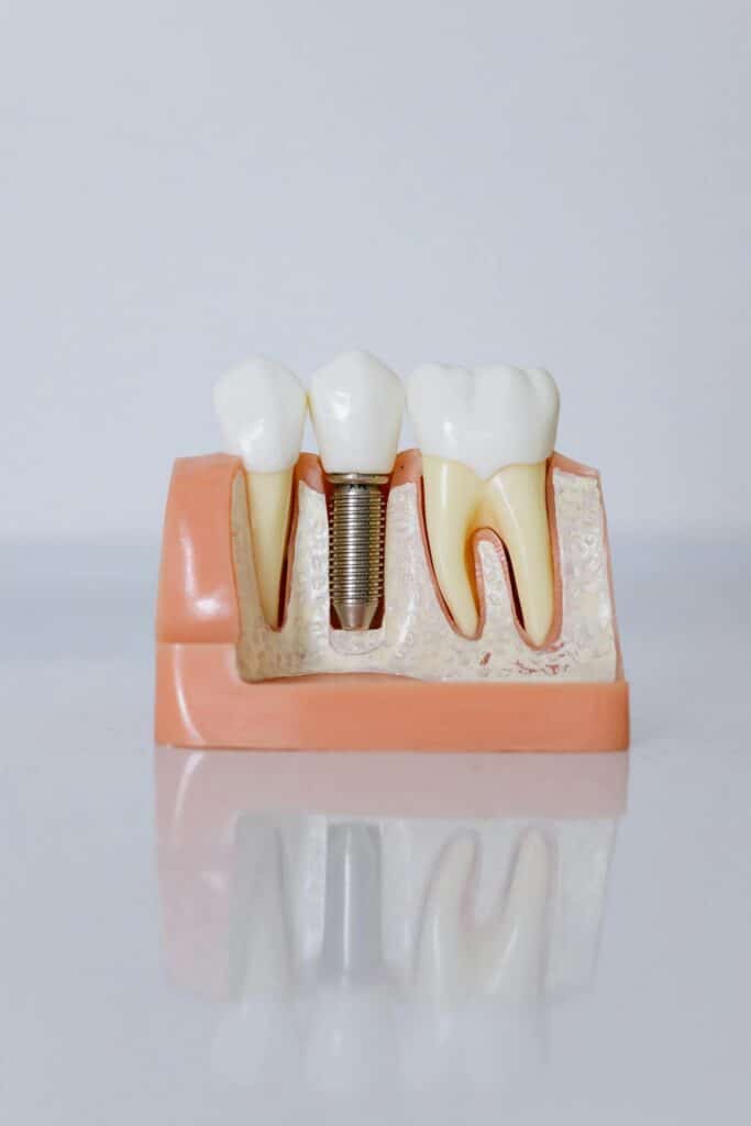 Implantes dentales San Juan de Mozarrifar