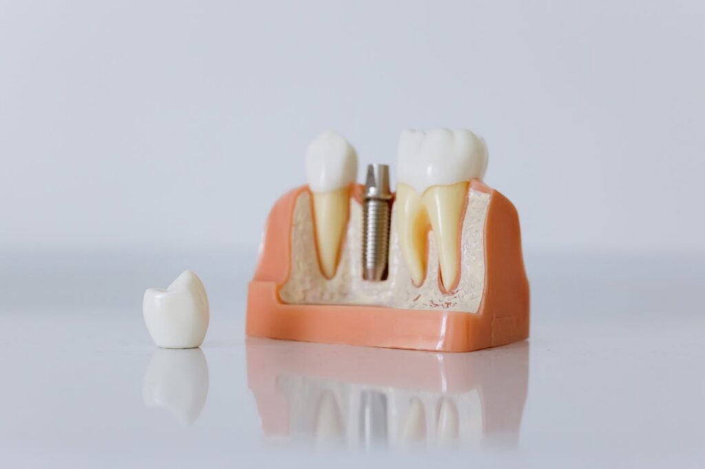 Implantes dentales Santa Isabel